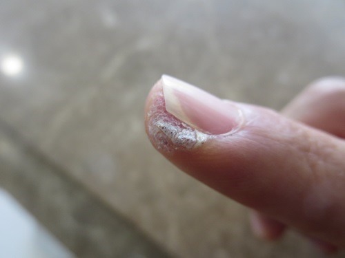 （写真３）右手の指先にあるカサカサしたウイルス性イボ（治療前）
