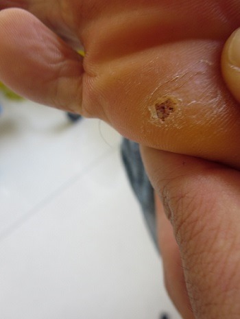 （写真２）右足の裏にある黒い点々がウイルス性いぼの部位