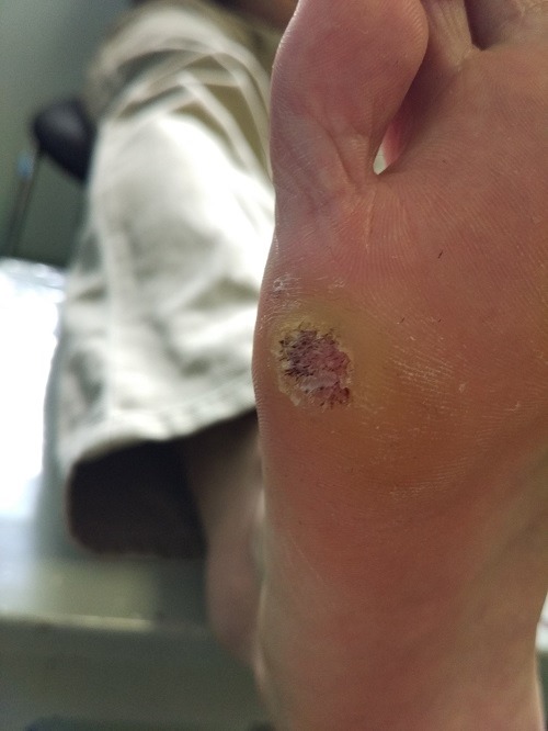 （写真４）苦しまされた足底のウイルス性イボ