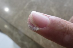 （写真１）人差し指にウイルス性イボが広がっている、とくに痛みはない